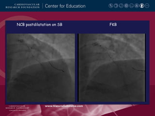 NCB postdilatation on SB

FKB

 