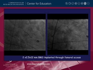 2 x2.5x12 mm BMS implanted through femoral access

 