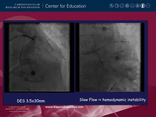 DES 3.5x30mm

Slow Flow >> hemodynamic instability

 