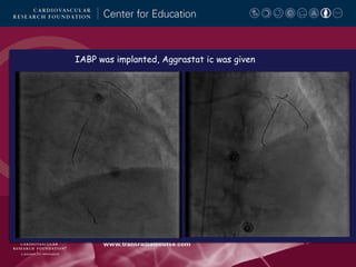 IABP was implanted, Aggrastat ic was given

 