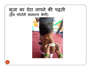 Child malnutrition in India-causes and solutions- hindi 2014