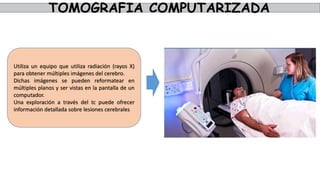 TOMOGRAFIA COMPUTARIZADA
Utiliza un equipo que utiliza radiación (rayos X)
para obtener múltiples imágenes del cerebro.
Dichas imágenes se pueden reformatear en
múltiples planos y ser vistas en la pantalla de un
computador.
Una exploración a través del tc puede ofrecer
información detallada sobre lesiones cerebrales
 