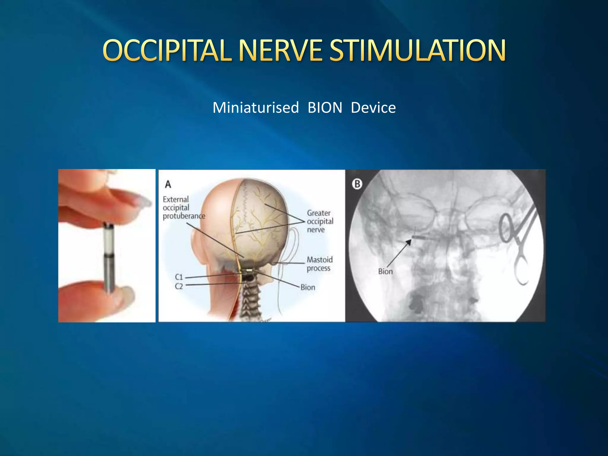 Dr Manjit Matharu - Rare TACS/Neurostimulation | PPTX | Brain and ...