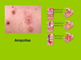 Ampollas 
