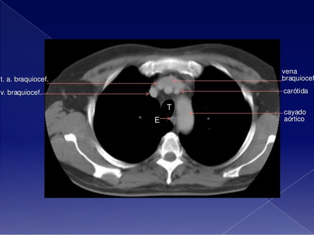 TAC DE TORAX ANATOMIA DOWNLOAD TAC DE TORAX ANATOMIA DOWNLOAD