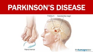 PARKINSON’S DISEASE
 
