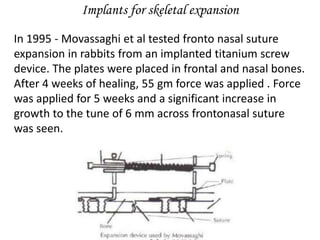 Implants for skeletal expansion
In 1995 - Movassaghi et al tested fronto nasal suture
expansion in rabbits from an implanted titanium screw
device. The plates were placed in frontal and nasal bones.
After 4 weeks of healing, 55 gm force was applied . Force
was applied for 5 weeks and a significant increase in
growth to the tune of 6 mm across frontonasal suture
was seen.
 