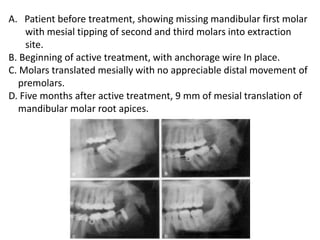 A. Patient before treatment, showing missing mandibular first molar
with mesial tipping of second and third molars into extraction
site.
B. Beginning of active treatment, with anchorage wire In place.
C. Molars translated mesially with no appreciable distal movement of
premolars.
D. Five months after active treatment, 9 mm of mesial translation of
mandibular molar root apices.
 
