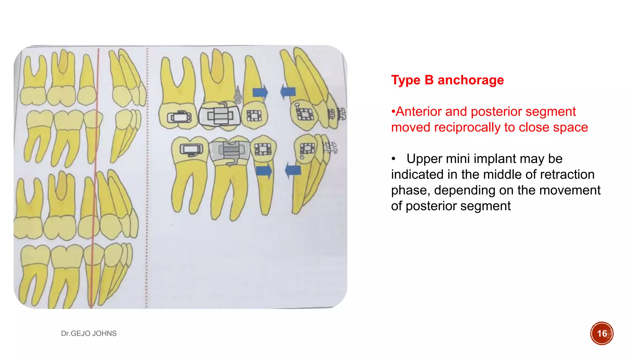 Bio-mechanics of TADS | PPTX