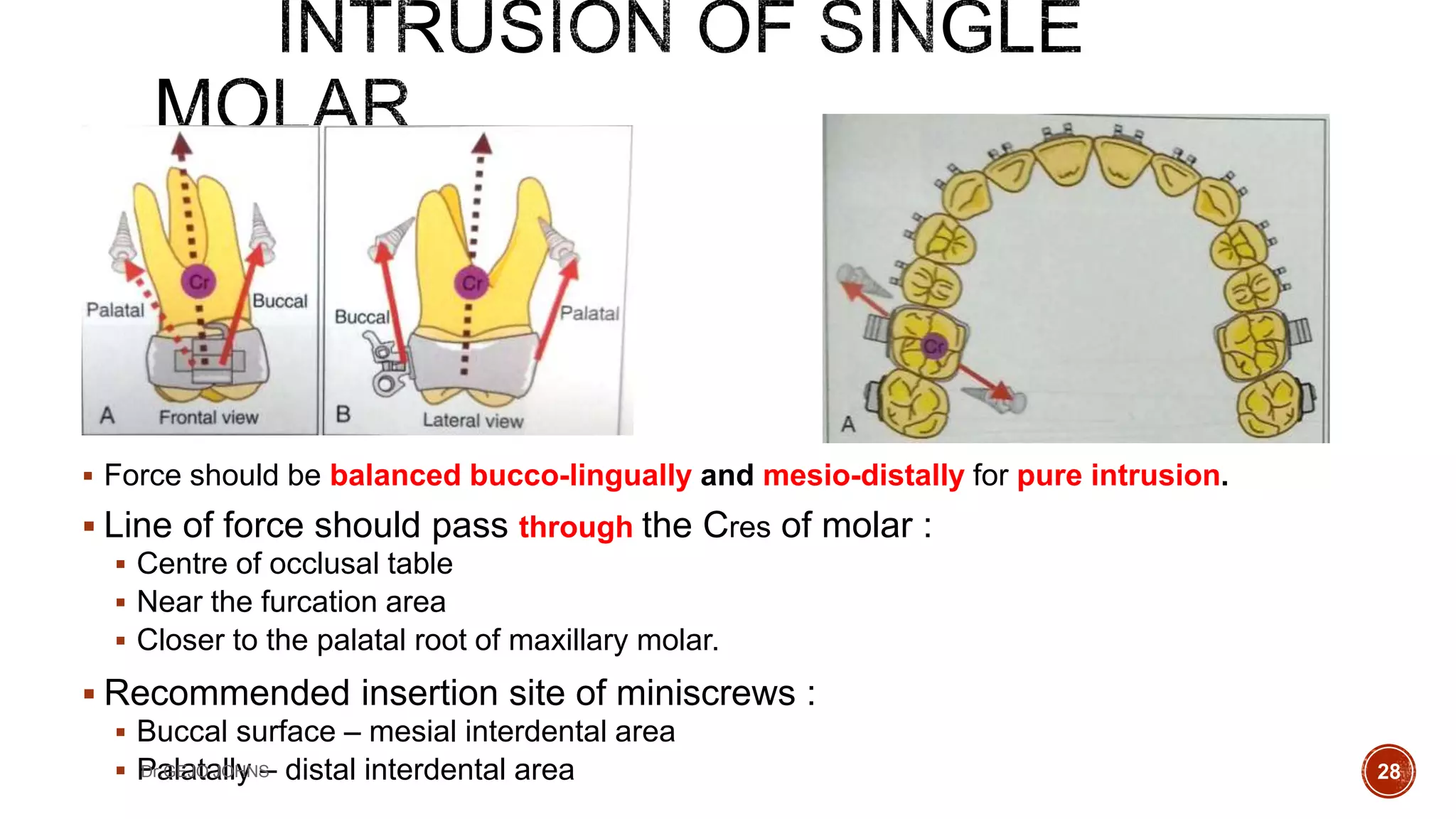 Bio-mechanics of TADS | PPTX
