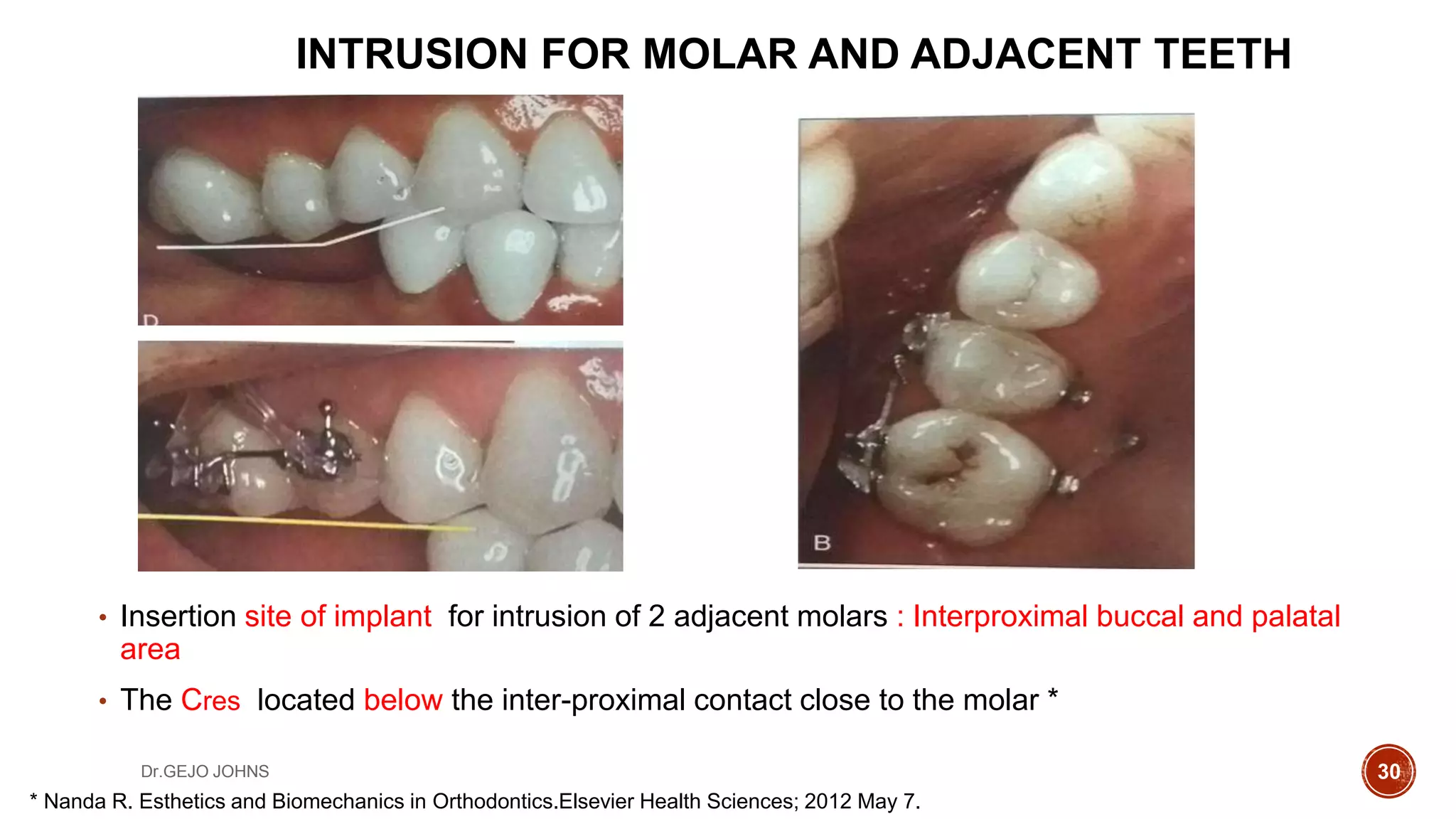 Bio-mechanics of TADS | PPTX