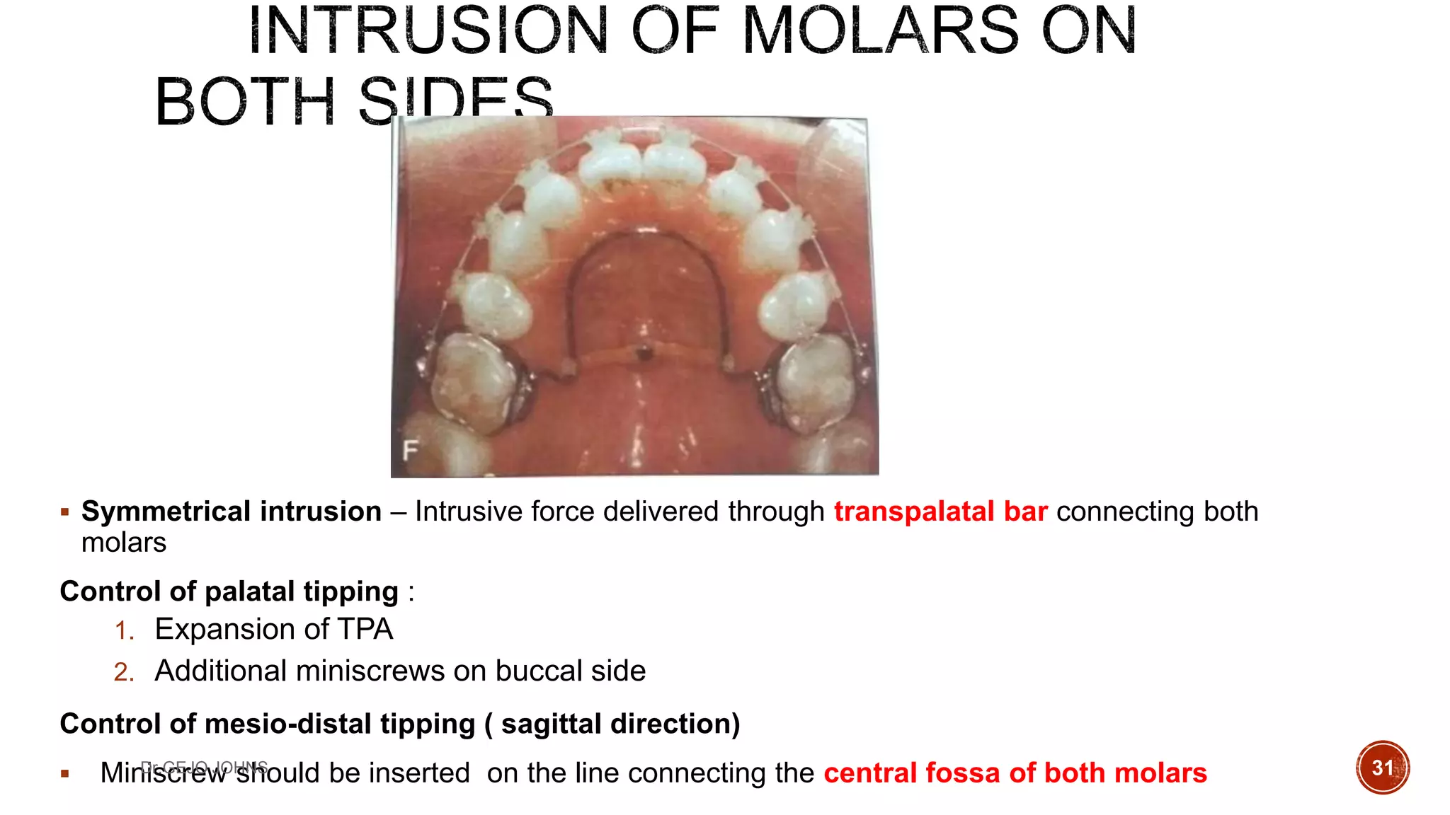 Bio-mechanics of TADS | PPTX