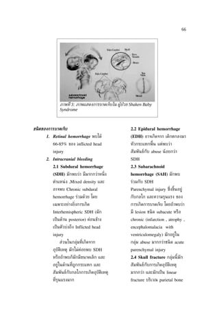 66




              ภาพท่ี 3: ภาพแสดงการบาดเจ็บใน ผููป่วย Shaken Baby
              Syndrome



ชนิ ดของการบาดเจ็บ                                 2.2 Epidural hemorrhage
       1. Retinal hemorrhage พบได้                 (EDH) อาจเกิดจาก เด็กตกลงมา
          66-85% ของ inflicted head                หัวกระแทกพ้ืน แต่พบว่า
          injury                                   สัมพันธ์กับ abuse น้ อยกว่า
       2. Intracranial bleeding                    SDH
          2.1 Subdural hemorrhage                  2.3 Subarachnoid
          (SDH) มักพบว่า มีมากกว่าหน่ ึง           hemorrhage (SAH) มักพบ
          ตำาแหน่ ง ,Mixed density และ             ร่วมกับ SDH
          อาจพบ Chronic subdural                   Parenchymal injury ซ่งขึ้นอยู่
                                                                        ึ
          hemorrhage ร่วมด้วย โดย                  กับกลไก และความรุนแรง ของ
          เฉพาะอย่างย่ิงการเกิด                    การเกิดการบาดเจ็บ โดยถ้าพบว่า
          Interhemispheric SDH (มัก                มี lesion ชนิ ด subacute หรือ
          เป็ นด้าน posterior) ค่อนข้าง            chronic (infarction , atrophy ,
          เป็ นตัวบ่งถึง Inflicted head            encephalomalacia with
          injury                                   ventriculomegaly) มักอยู่ใน
              ส่วนในกลุ่มท่ีเกิดจาก                กลุ่ม abuse มากกว่าชนิ ด acute
          อุบัติเหตุ มักไม่ค่อยพบ SDH              parenchymal injury
          หรือถ้าพบก็มักมีขนาดเล็ก และ             2.4 Skull fracture กลุ่มนี้มัก
          อยู่ในด้านท่ีถูกกระแทก และ               สัมพันธ์กับการเกิดอุบัติเหตุ
          สัมพันธ์กับกลไกการเกิดอุบัติเหตุ         มากกว่า และมักเป็ น linear
          ท่ีรุนแรงมาก                             fracture บริเวณ parietal bone
 