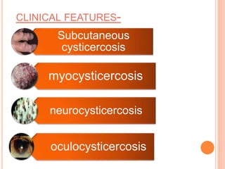 CLINICAL FEATURES-
Subcutaneous
cysticercosis
myocysticercosis
neurocysticercosis
oculocysticercosis
 