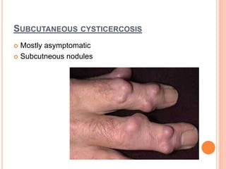 SUBCUTANEOUS CYSTICERCOSIS
 Mostly asymptomatic
 Subcutneous nodules
 
