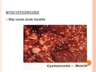 MYOCYSTICERCOSIS
 May cause acute myositis
 