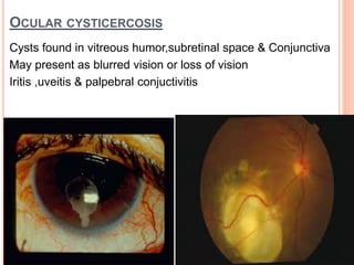 OCULAR CYSTICERCOSIS
Cysts found in vitreous humor,subretinal space & Conjunctiva
May present as blurred vision or loss of vision
Iritis ,uveitis & palpebral conjuctivitis
 