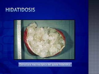 Estructura macroscópica del quiste hidatídico
 