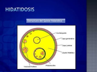 Estructura del Quiste hidatídico
 