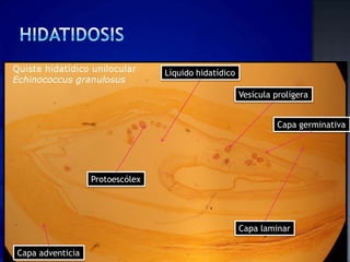 Líquido hidatídico

                                                      Vesícula prolígera


                                                               Capa germinativa




                  Protoescólex




                                                      Capa laminar

Capa adventicia
 