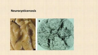 Neurocysticercosis
 