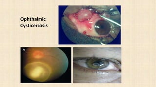 Ophthalmic
Cysticercosis
 