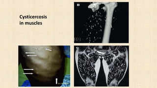 Cysticercosis
in muscles
 