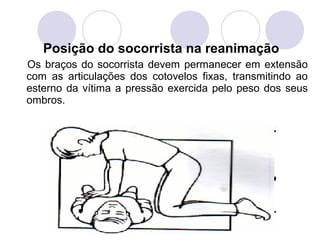 Posição do socorrista na reanimação
Os braços do socorrista devem permanecer em extensão
com as articulações dos cotovelos fixas, transmitindo ao
esterno da vítima a pressão exercida pelo peso dos seus
ombros.
 