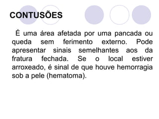 CONTUSÕES

  É uma área afetada por uma pancada ou
queda sem ferimento externo. Pode
apresentar sinais semelhantes aos da
fratura fechada. Se o local estiver
arroxeado, é sinal de que houve hemorragia
sob a pele (hematoma).
 