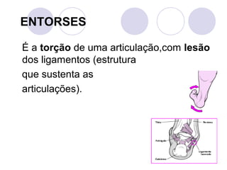 ENTORSES

É a torção de uma articulação,com lesão
dos ligamentos (estrutura
que sustenta as
articulações).
 