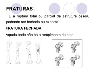 FRATURAS
 É a ruptura total ou parcial da estrutura óssea,
podendo ser fechada ou exposta.
FRATURA FECHADA
Aquela onde não há o rompimento da pele
 