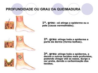 PROFUNDIDADE OU GRAU DA QUEIMADURA


                1º. grau : só atinge a epiderme ou a
                pele (causa vermelhidão).




                 2º. grau: atinge toda a epiderme e
                 parte da derme (forma bolhas).




                 3º. grau: atinge toda a epiderme, a
                 derme e outros tecidos mais profundos,
                 podendo chegar até os ossos. Surge a
                 cor preta, devido a carbonização dos
                 tecidos.
 