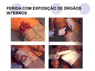 FERIDA COM EXPOSIÇÃO DE ÓRGÃOS
INTERNOS
 