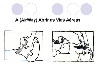 A (AirWay) Abrir as Vias Aéreas
 