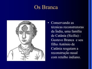 Os Branca
• Conservando as
técnicas reconstrutoras
da Índia, uma família
de Catânia (Sicília) :
Gustavo Branca e seu
filho Antônio de
Catânia resgatam a
reconstrução nasal
com retalho indiano.
 