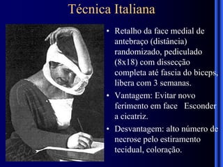 Técnica Italiana
• Retalho da face medial de
antebraço (distância)
randomizado, pediculado
(8x18) com dissecção
completa até fascia do biceps,
libera com 3 semanas.
• Vantagem: Evitar novo
ferimento em face Esconder
a cicatriz.
• Desvantagem: alto número de
necrose pelo estiramento
tecidual, coloração.
 