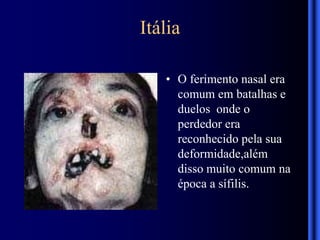 Itália
• O ferimento nasal era
comum em batalhas e
duelos onde o
perdedor era
reconhecido pela sua
deformidade,além
disso muito comum na
época a sífilis.
 