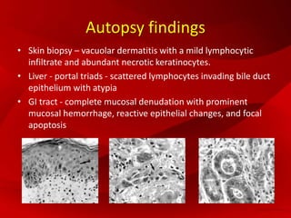 Autopsy findings
• Skin biopsy – vacuolar dermatitis with a mild lymphocytic
infiltrate and abundant necrotic keratinocytes.
• Liver - portal triads - scattered lymphocytes invading bile duct
epithelium with atypia
• GI tract - complete mucosal denudation with prominent
mucosal hemorrhage, reactive epithelial changes, and focal
apoptosis
 