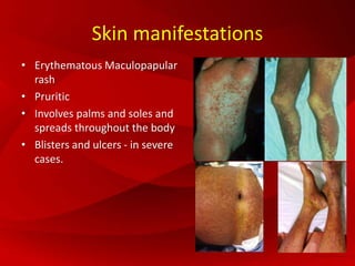 Skin manifestations
• Erythematous Maculopapular
rash
• Pruritic
• Involves palms and soles and
spreads throughout the body
• Blisters and ulcers - in severe
cases.
 