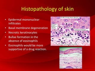 Histopathology of skin
• Epidermal mononuclear
infiltrates
• Basal membrane degeneration
• Necrotic keratinocytes
• Bullae formation in the
absence of eosinophils
• Eosinophils would be more
supportive of a drug reaction.
 