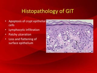 Histopathology of GIT
• Apoptosis of crypt epithelial
cells
• Lymphocytic infiltration
• Patchy ulceration
• Loss and flattening of
surface epithelium
 