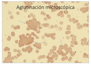 Aglutinación microscópica
 
