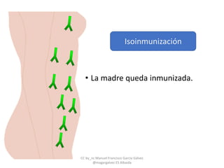 • La madre queda inmunizada.
Isoinmunización
CC by_nc Manuel Francisco García Gálvez
@magargalvez ES Albaida
 