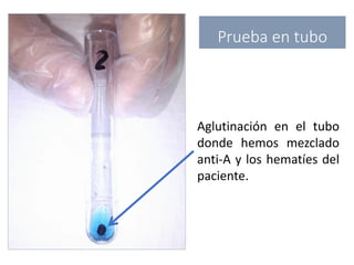 Aglutinación en el tubo
donde hemos mezclado
anti-A y los hematíes del
paciente.
Prueba en tubo
 