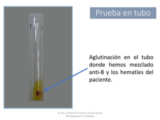 Aglutinación en el tubo
donde hemos mezclado
anti-B y los hematíes del
paciente.
Prueba en tubo
CC by_nc Manuel Francisco García Gálvez
@magargalvez ES Albaida
 