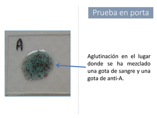 Prueba en porta
Aglutinación en el lugar
donde se ha mezclado
una gota de sangre y una
gota de anti-A.
 