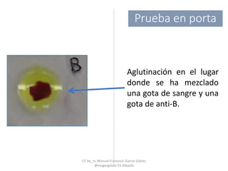 Aglutinación en el lugar
donde se ha mezclado
una gota de sangre y una
gota de anti-B.
Prueba en porta
CC by_nc Manuel Francisco García Gálvez
@magargalvez ES Albaida
 