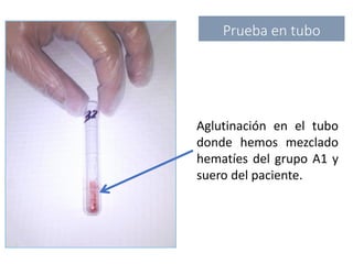 Aglutinación en el tubo
donde hemos mezclado
hematíes del grupo A1 y
suero del paciente.
Prueba en tubo
 