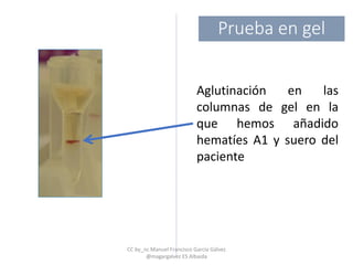 Aglutinación en las
columnas de gel en la
que hemos añadido
hematíes A1 y suero del
paciente
Prueba en gel
CC by_nc Manuel Francisco García Gálvez
@magargalvez ES Albaida
 