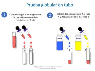 1 Colocar dos gotas de suspensión
de hematíes en dos tubos
rotulados con A y B
2
Colocar dos gotas de anti-A al tubo
A y dos gotas de anti-B al tubo B
Prueba globular en tubo
CC by_nc Manuel Francisco García Gálvez
@magargalvez ES Albaida
 